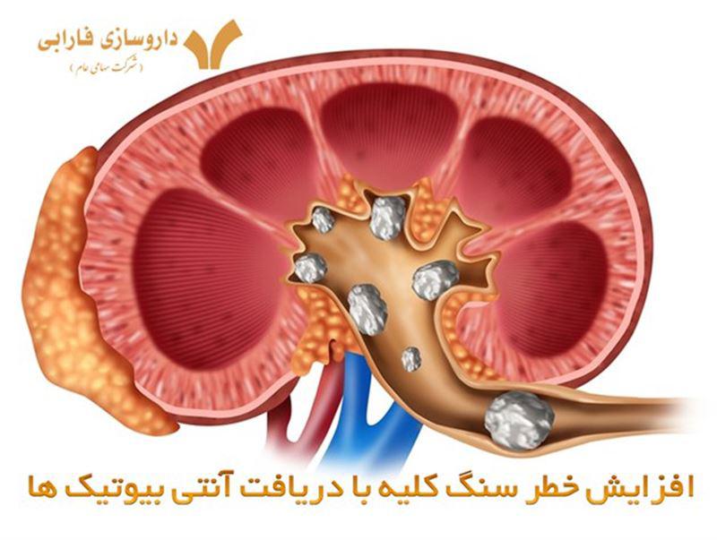 سنگ كليه