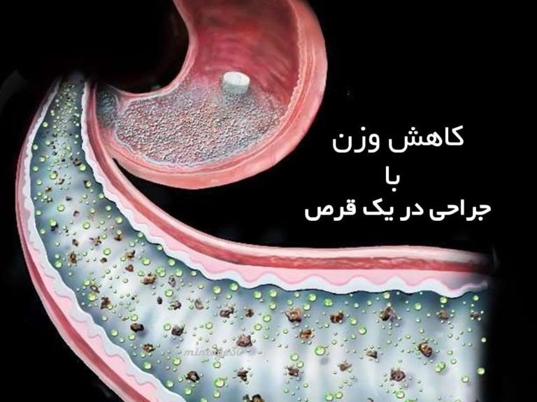 دیابت نوع 2